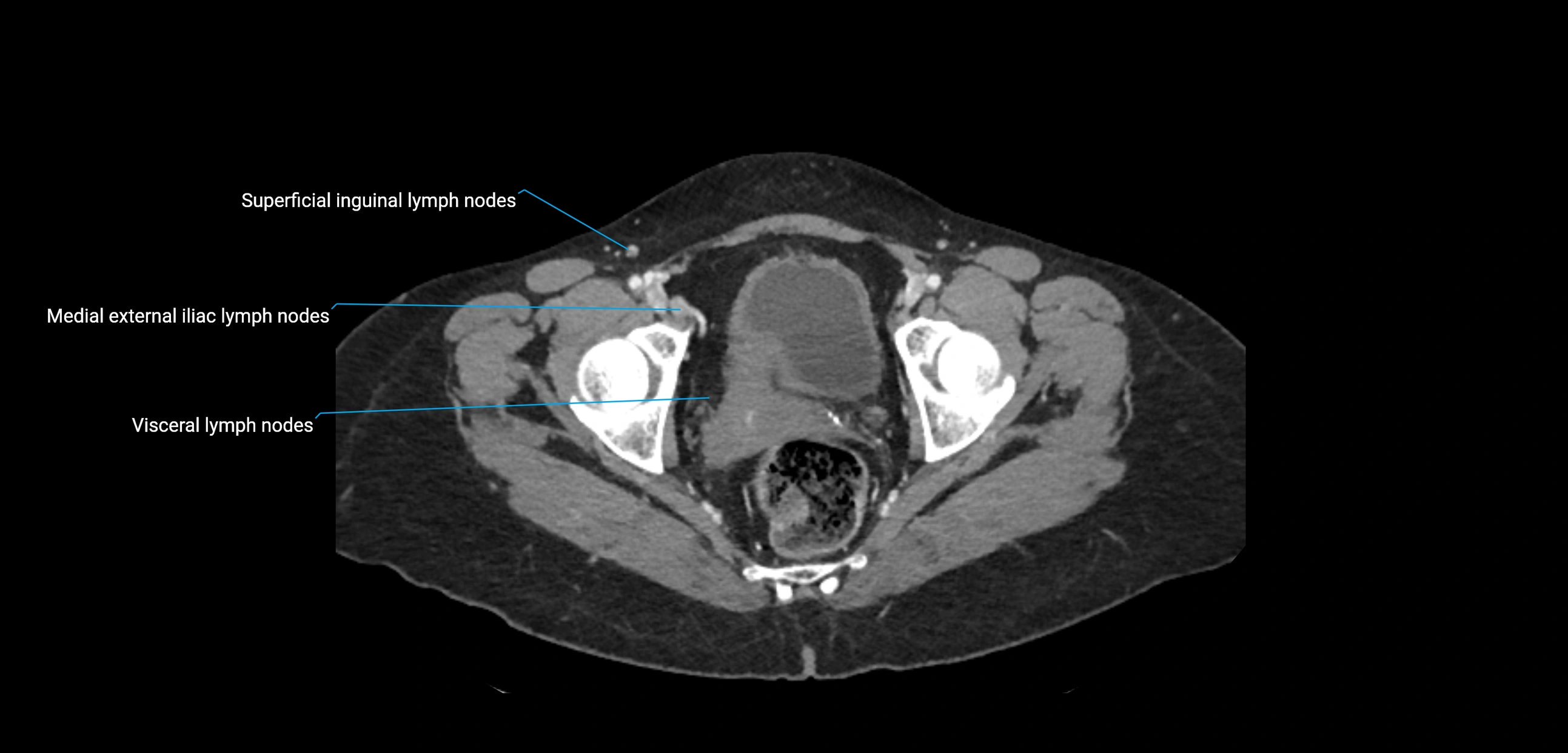 CT ct abdominal lymph nodes  axial cross sectional anatomy  enchanced radiology image -img-00002-00384.webp